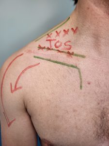 Marker diagram on a TOS patient. Thoracic Outlet is above the collar bone and below the neck muscle.