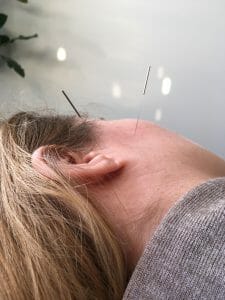 Two needles on the face of a woman part of the therapy