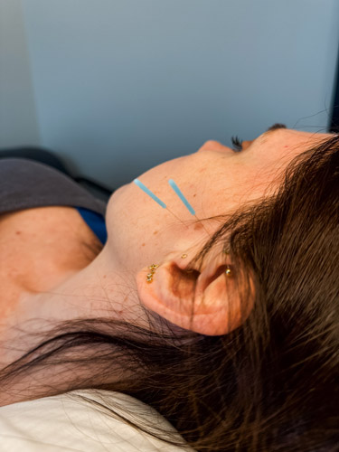 A female patient receiving acupuncture treatment for TMJ pain