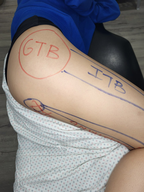 A picture showing what GTB is with marks on patient's leg for effected areas