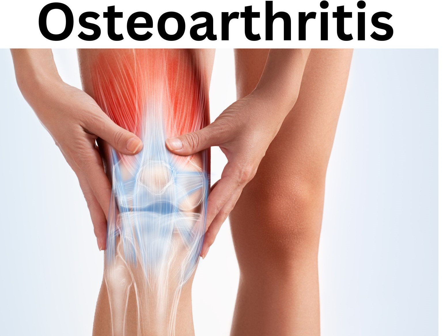 A graphic showing what osteoarthritis is, where a person is holding his knee