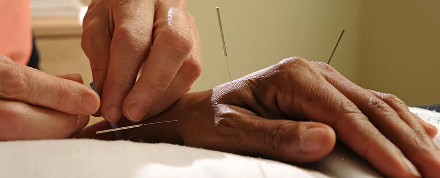 Acupuncture in Oakville