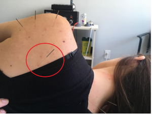 Acupuncture near me. Acupuncture pain treatment.