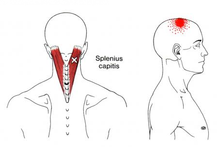 oakville chiropractor splenius capitus muscle pain