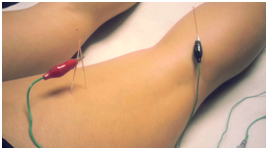 Oakville Acupuncture: 2 needles on the back of a leg with what looks like little car boosting leads on the end, these electrify the needles deep in the muscle