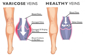 How compression stockings work