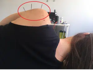 Acupuncture for migaines and headaches in oakville needles in neck muscle